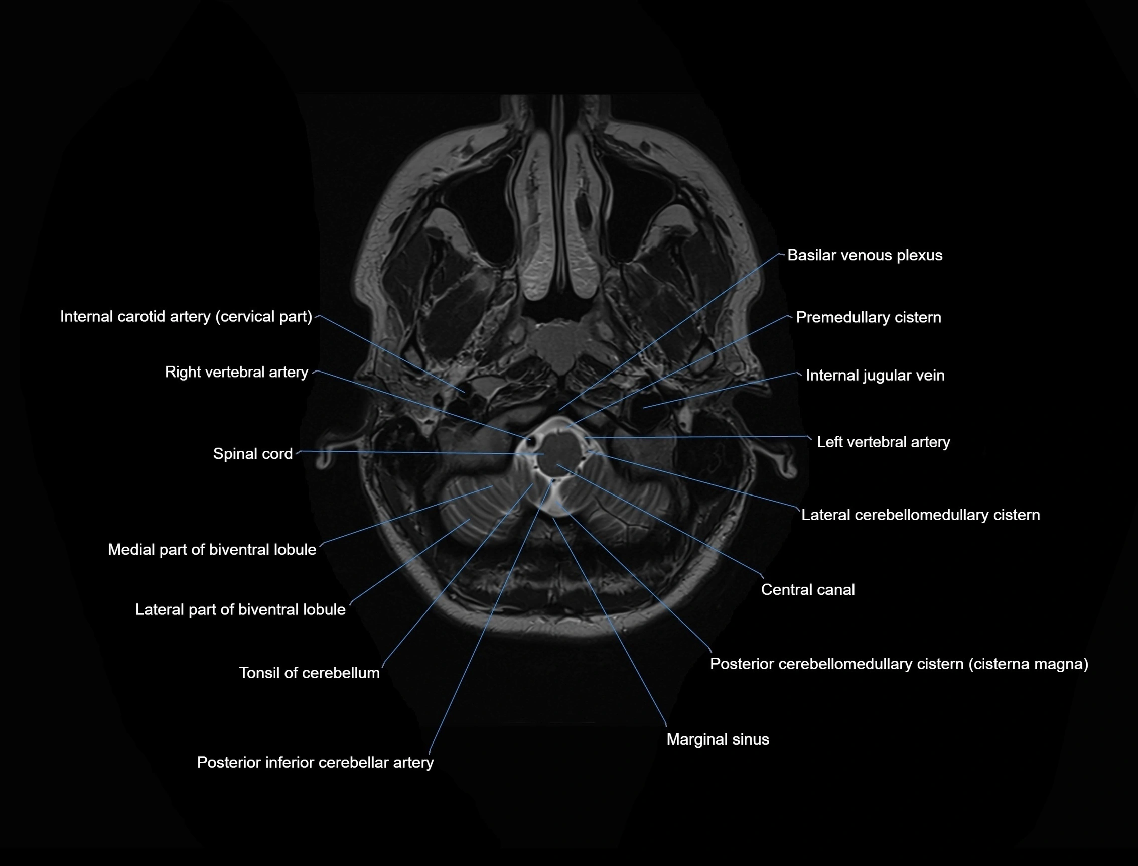 MRI Brain axial cross sectional radiology anatomy 3T image  -img-00001-00004.webp